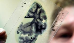 Австралийски учени ще създават бионичен мозък