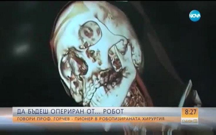 Да бъдеш опериран от... робот