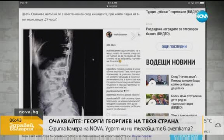 Гръбнакът на Цвети Стоянова прикрепен с пластини