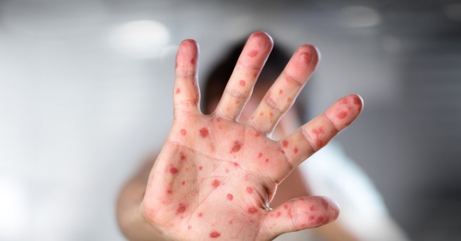 Здравното министерство призова родителите за спешна имунизация заради епидемията на