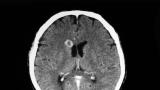  <br> Защо пациентка се радва на <strong> свинска тения в мозъка </strong>? <br> 