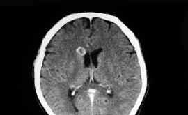  <p>Защо пациентка се радва на<strong> свинска тения в мозъка</strong>?</p> 