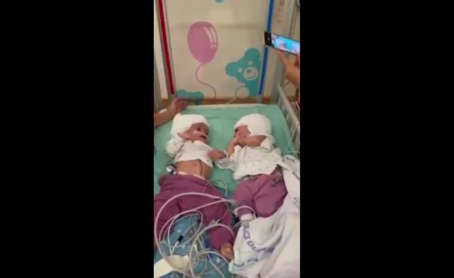 Сензационна операция: разделиха сиамски близнаци, свързани в главата