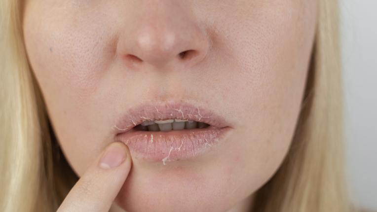 Напукани, парещи, сухи: какво издават устните за здравето ни