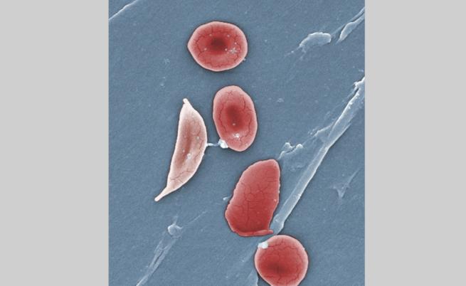 За първи път в света: Преляха на човек отгледани в лаборатория червени кръвни клетки