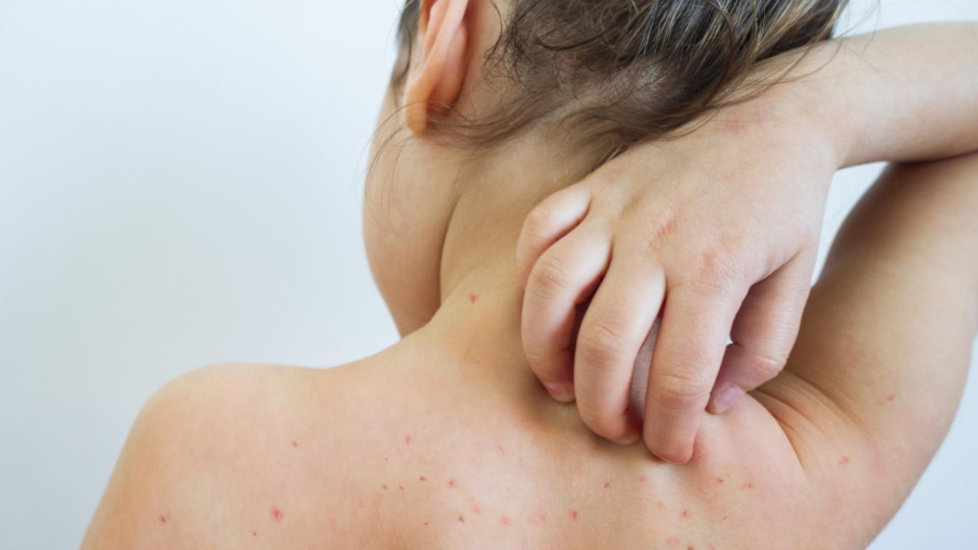 Имунизацията срещу варицела и респираторно синцитиален вирус да стане задължителна предлага