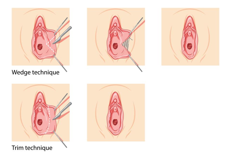 операция вагинопластика