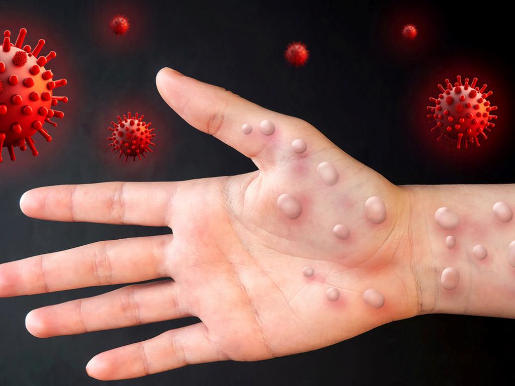 Аlaskapox сравнително новодошла болест на микробиологичната сцена бе преименувана на Вorealpox Решението