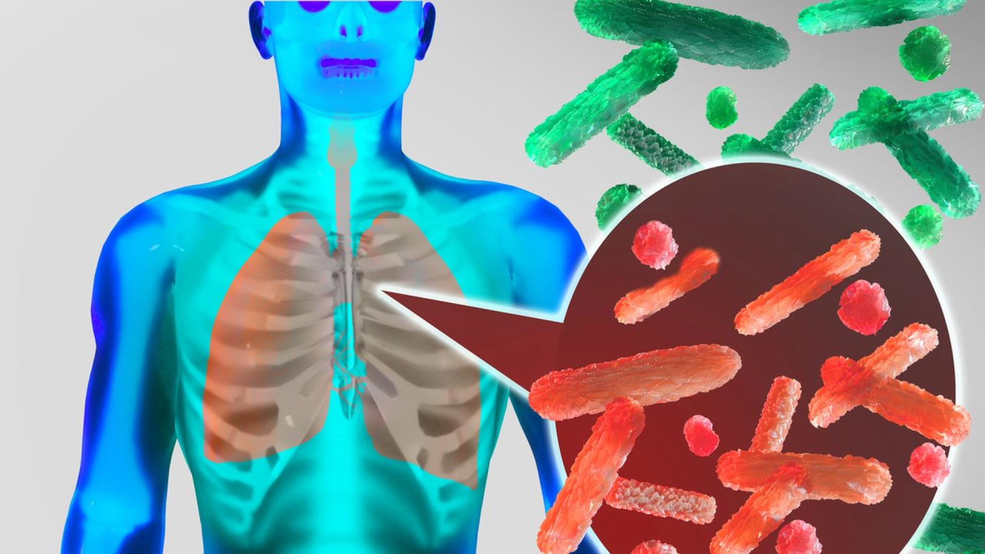 Нюйоркчанин почина а най малко 22 други се разболяха при огнище