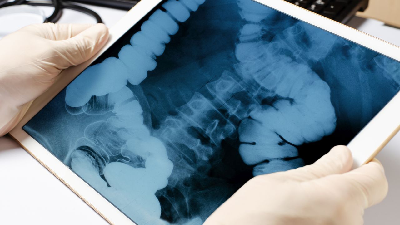 Оперираха момче, след като погълнало 100 магнита и те заседнали в червата му