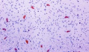 Странната болест, която уби половин милион души и след това внезапно изчезна