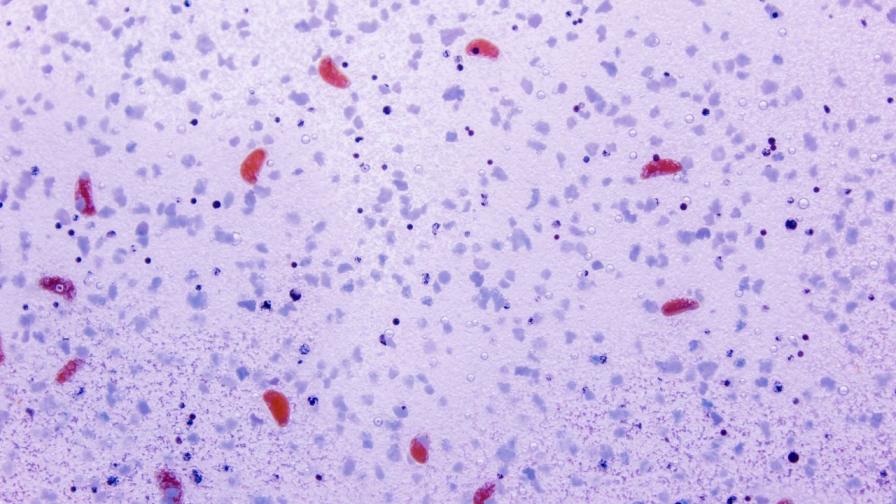 Странната болест, която уби половин милион души и след това внезапно изчезна