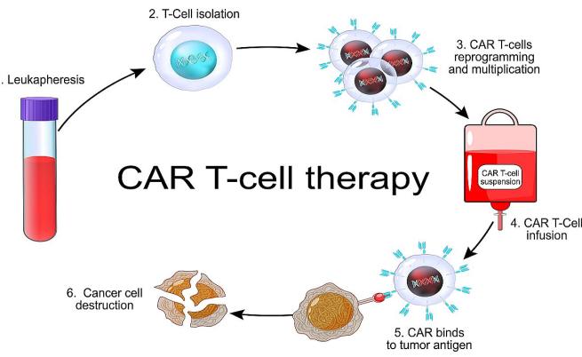 CAR T-клетъчна терапия (Снимката е илюстративна)