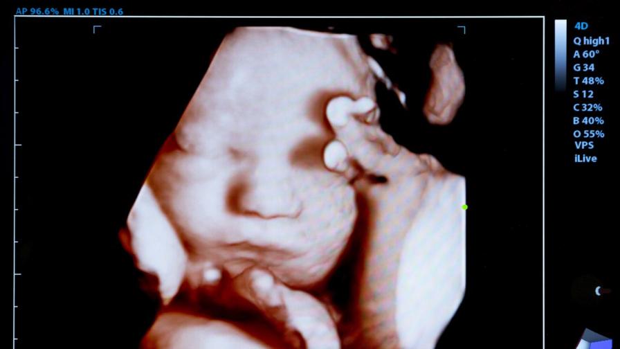 Чудото на живота! Бебе се усмихва на ултразвук, чувайки гласа на баща си (ВИДЕО)