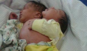 Бебе с две глави се роди в Бразилия